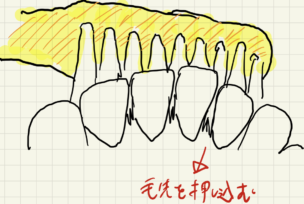 つまようじ法ブラッシング